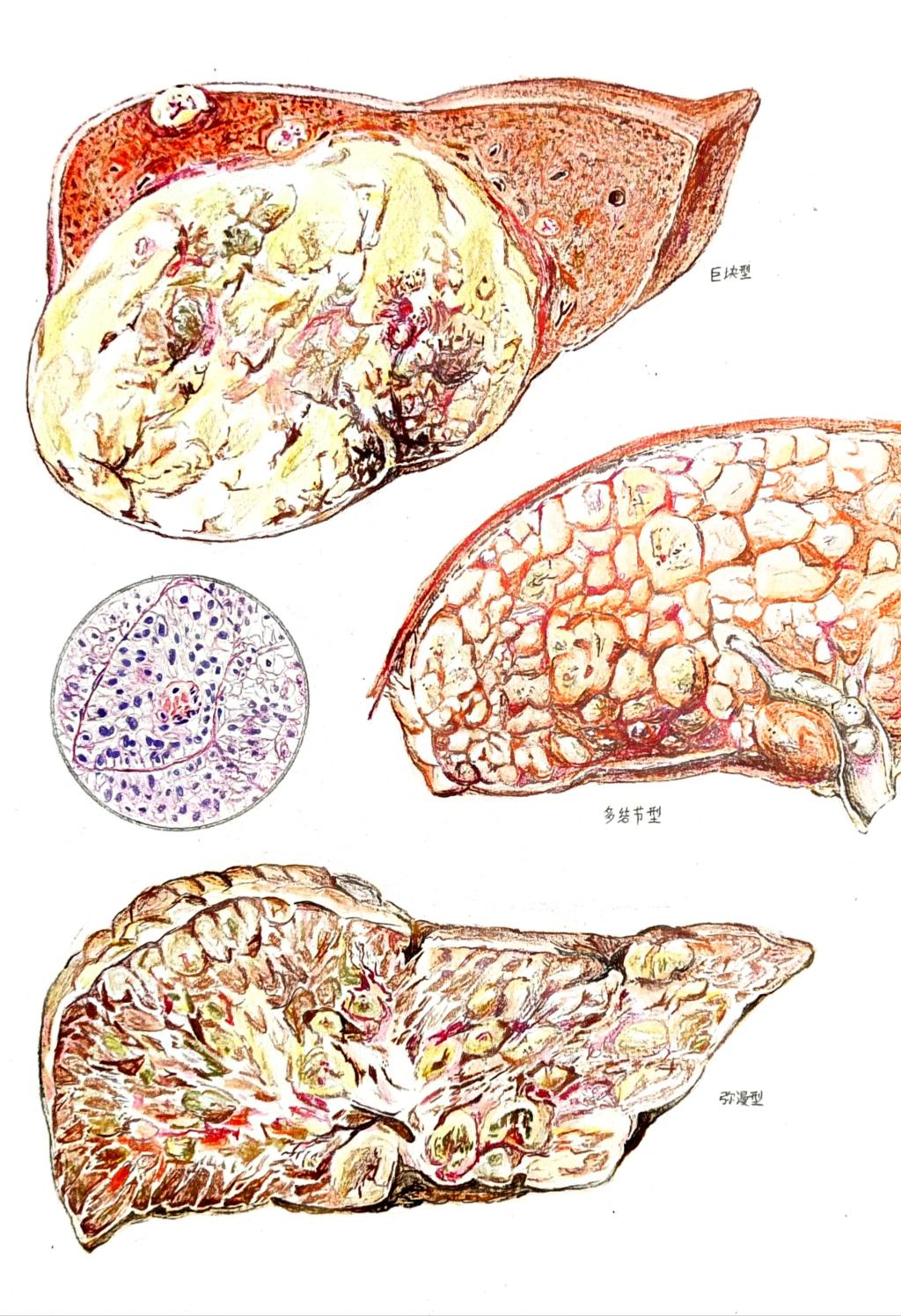 5. 邮寄手绘 作品分类 2 肝细胞癌的病理变化 91国产自拍
 韩培航